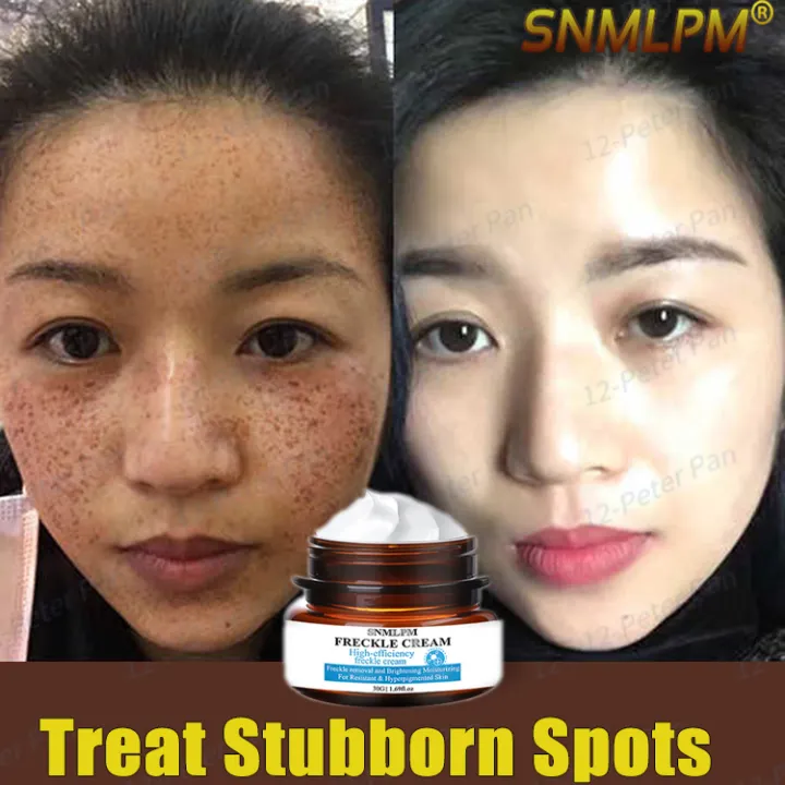 snmlpm freckle cream