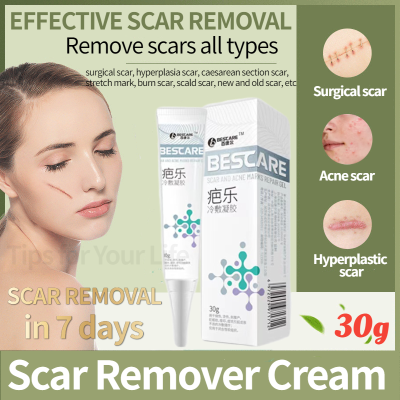 【100% effective】Scar remover cream original 30g Peklat remover for old ...