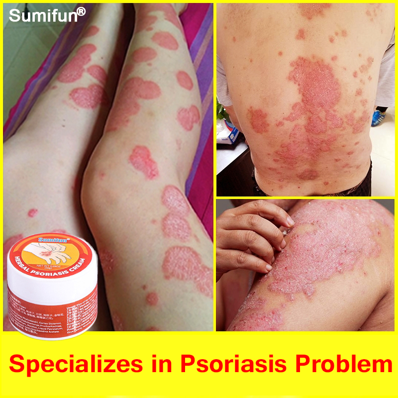 Sumifun Herbal Psoriasis Cream Antifungal Cream Eczema Treatment Cream