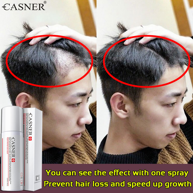 Quick results CASNER Hair Growth Essence Oil Anti Hair loss Solve The  Problem Of Baldness Accelerate Hair Regrowth Improve Hair Quality Hair Loss  Treatment Hair Care Hair Restore Hair Treatment Hair Grower