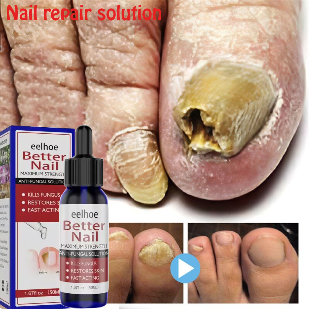 【Effective in 7 days】ORIGINAL 50ml Eelhoe Nail Fungal Solution Foot Nail Fungus Removal Gel Anti