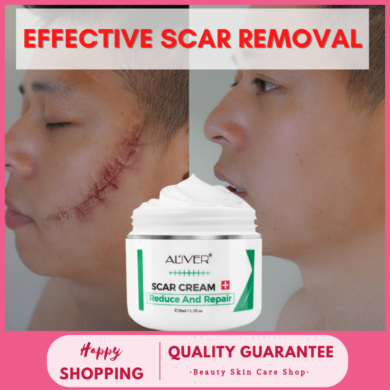 【Ready Stock in Manila】ALIVER Effective Scar Remover Cream for New Old ...