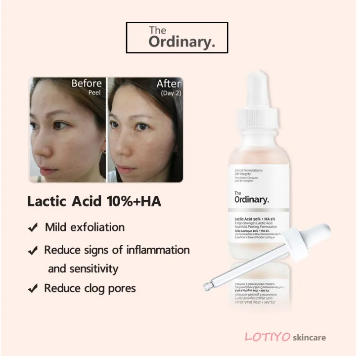 the ordinary lactic acid acne