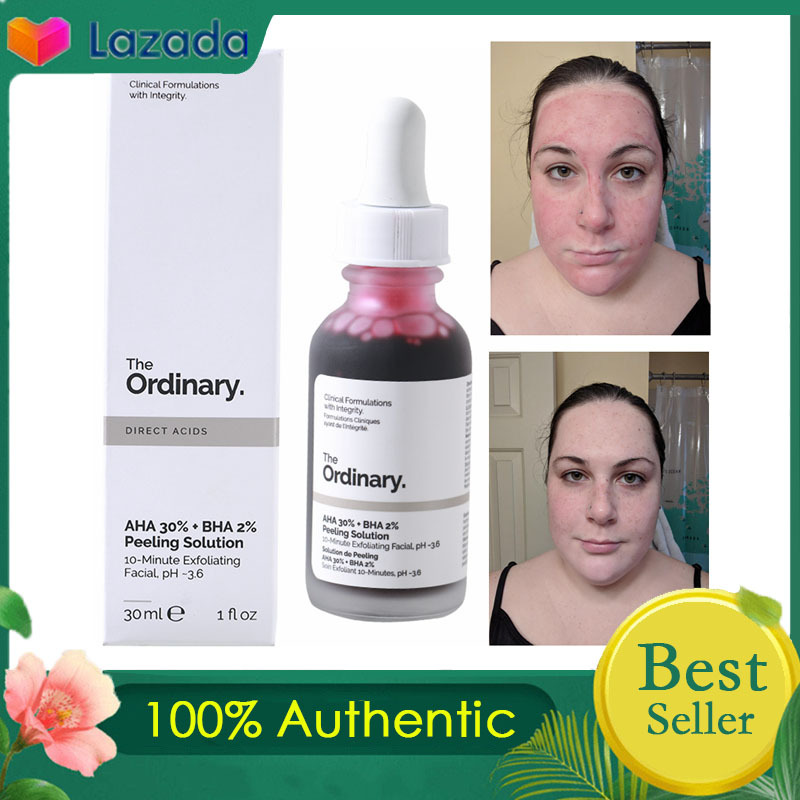 best peeling solution for acne scars