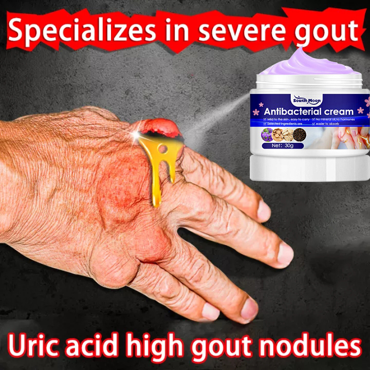 【Quick Itch Relief】Psoriasis Cream Eczema treatment cream 30g Antiitch