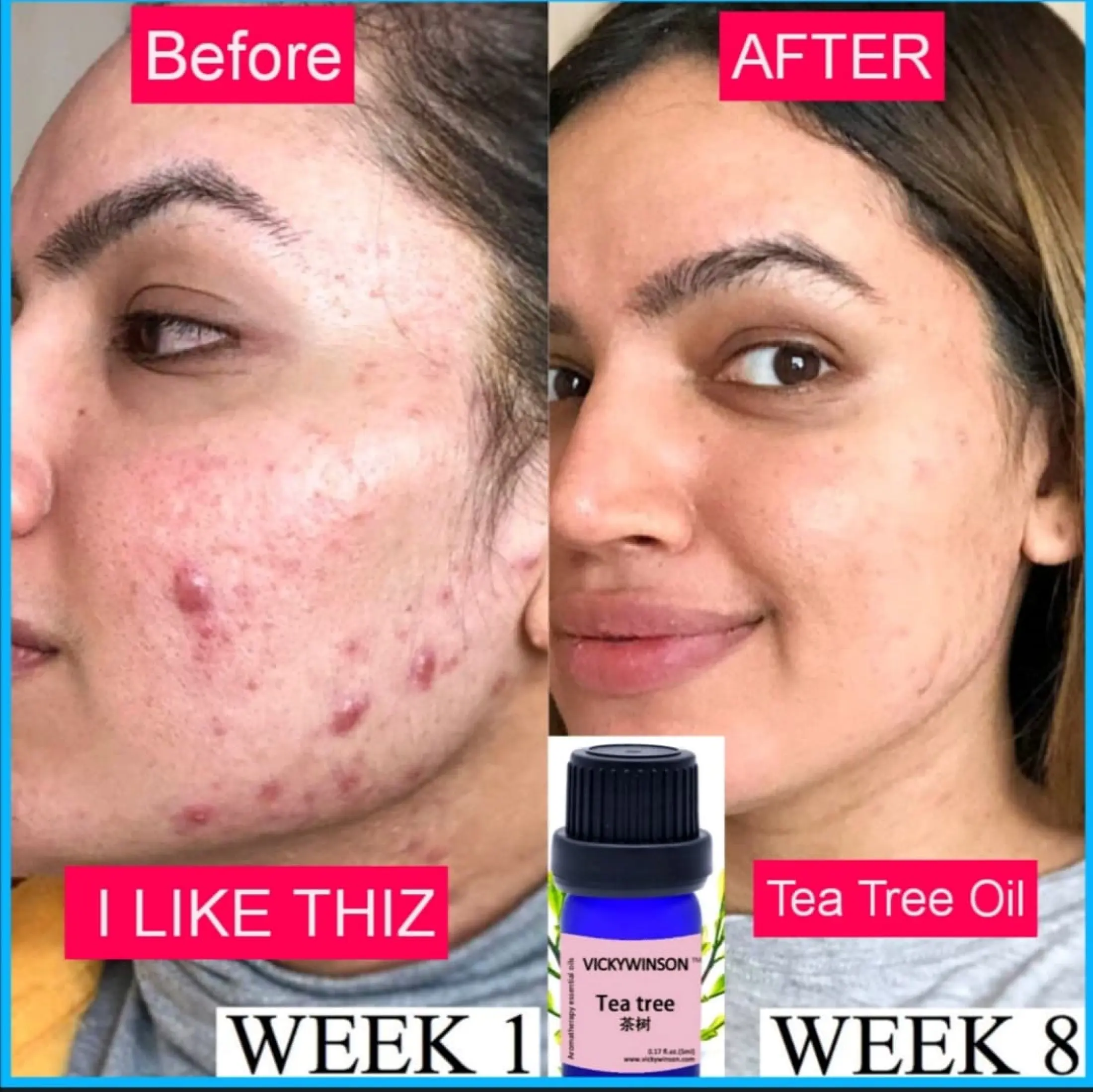 best essential oil for acne scars