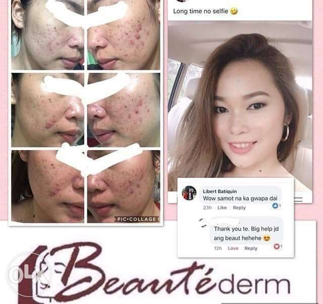 beautederm for pimple marks