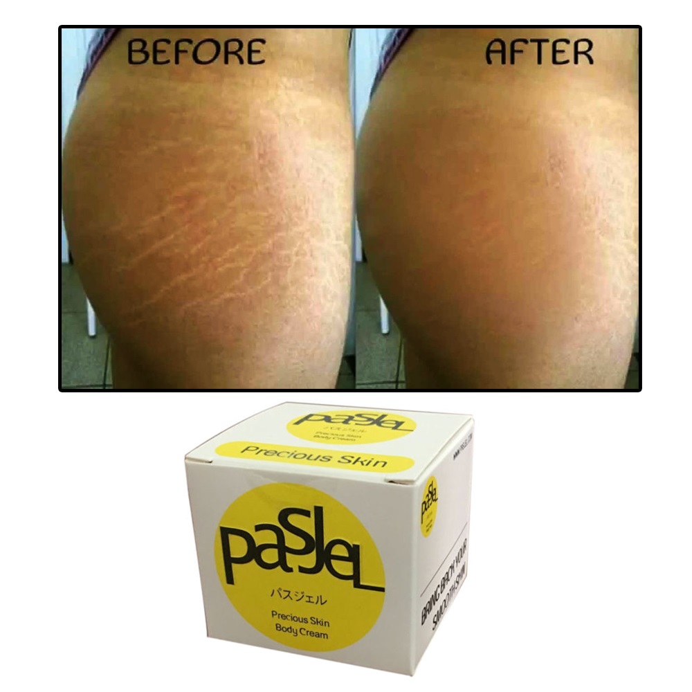 pasjel for stretch marks