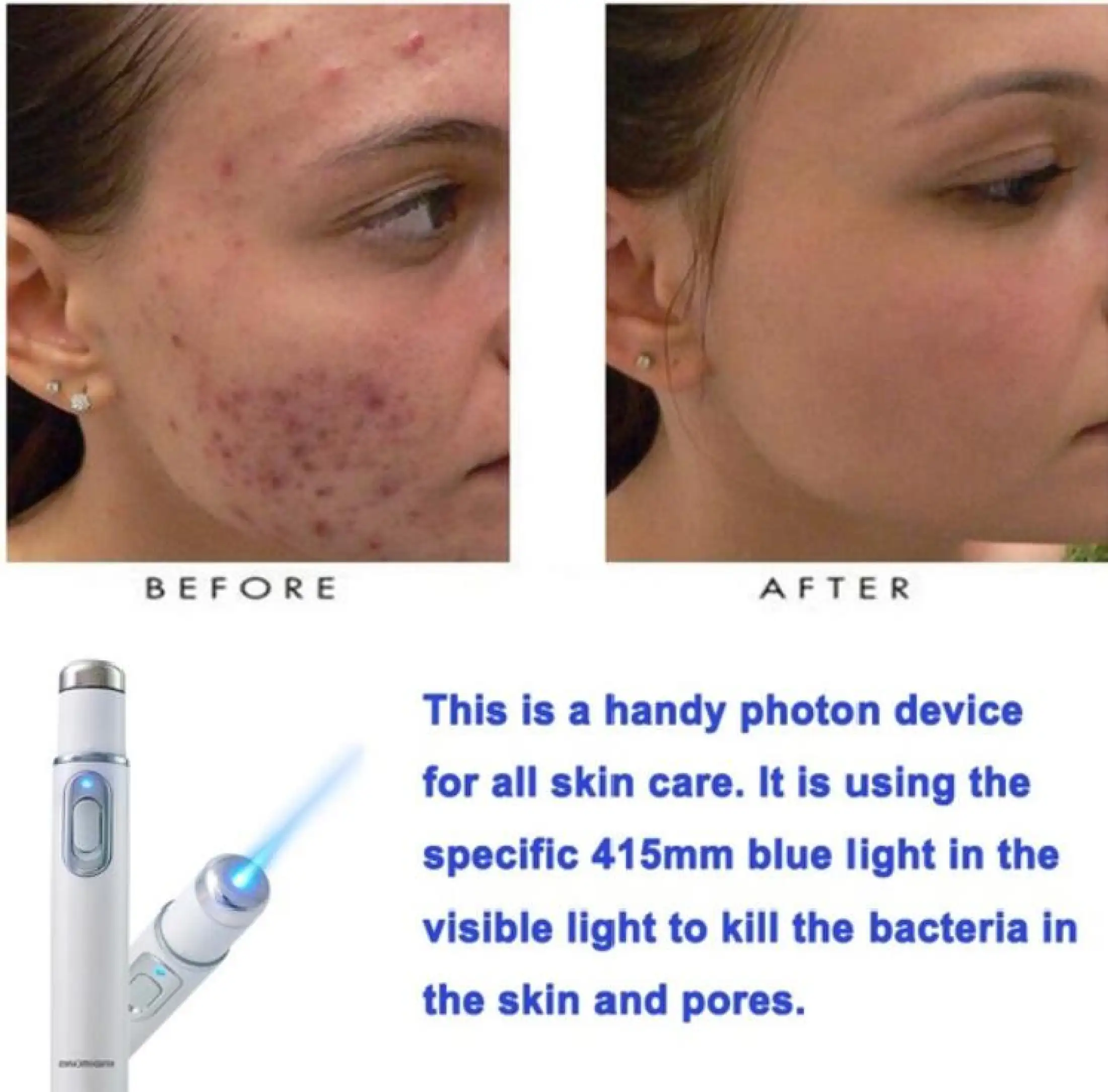 Authentic Medical Blue Light Therapy Laser Treatment Pen Acne Scar Wrinkle Removal Device Lazada Ph