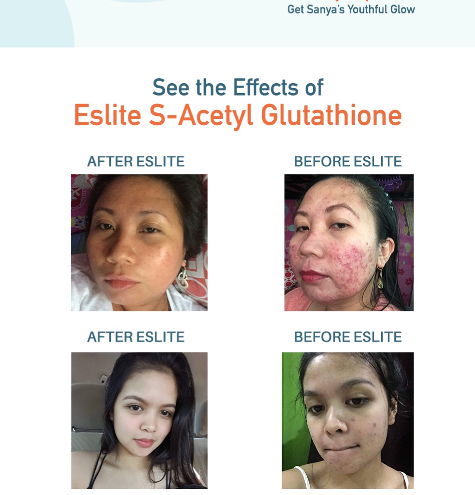 eslite glutathione before and after BEST PILLS 2021 (Eslite Review, Philippines) Join our FB Live on