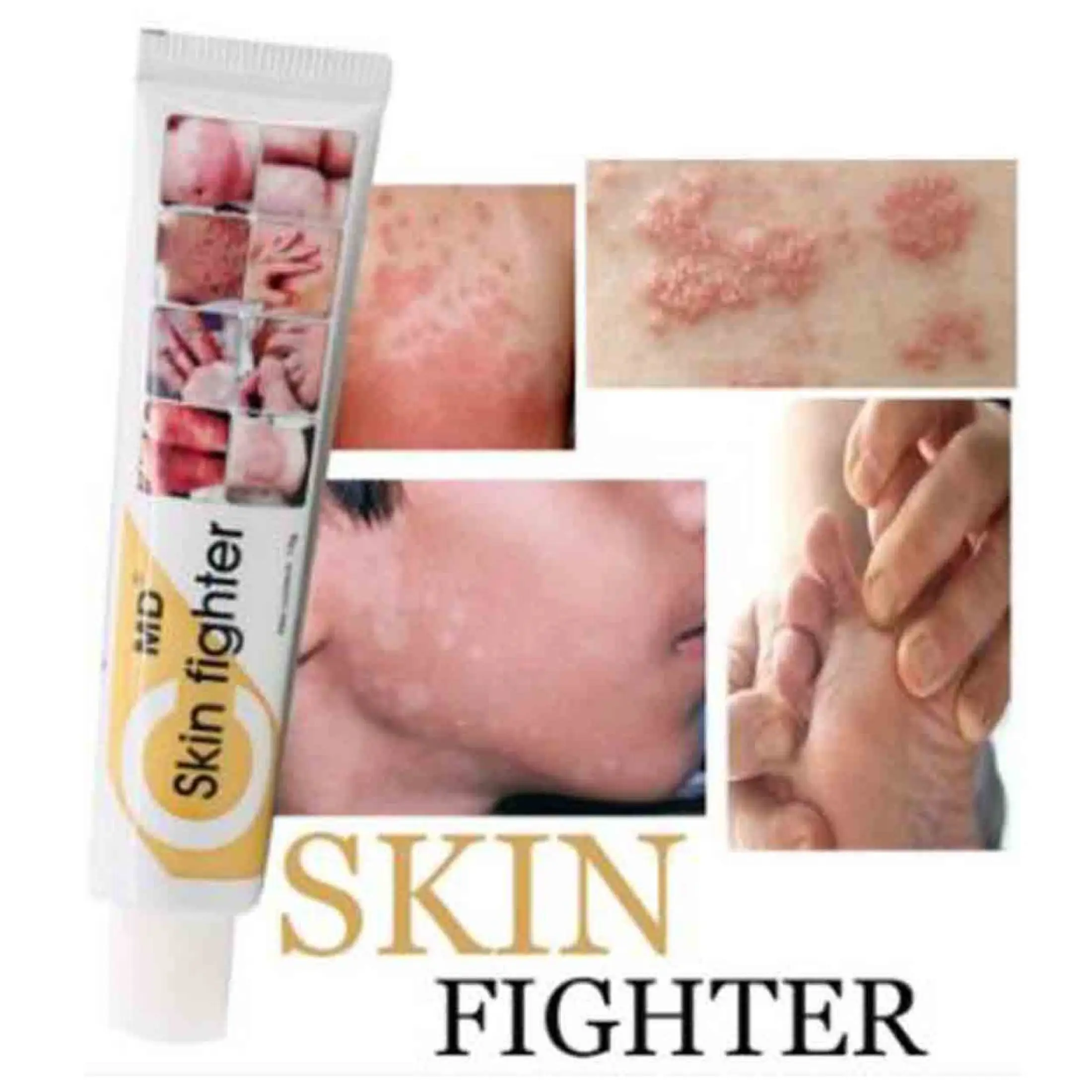 skin fighter for pimples