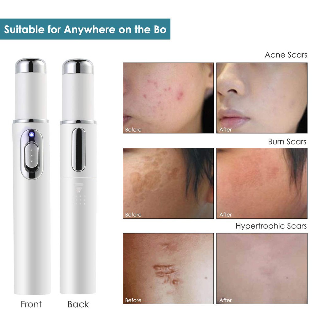 blue light acne treatment