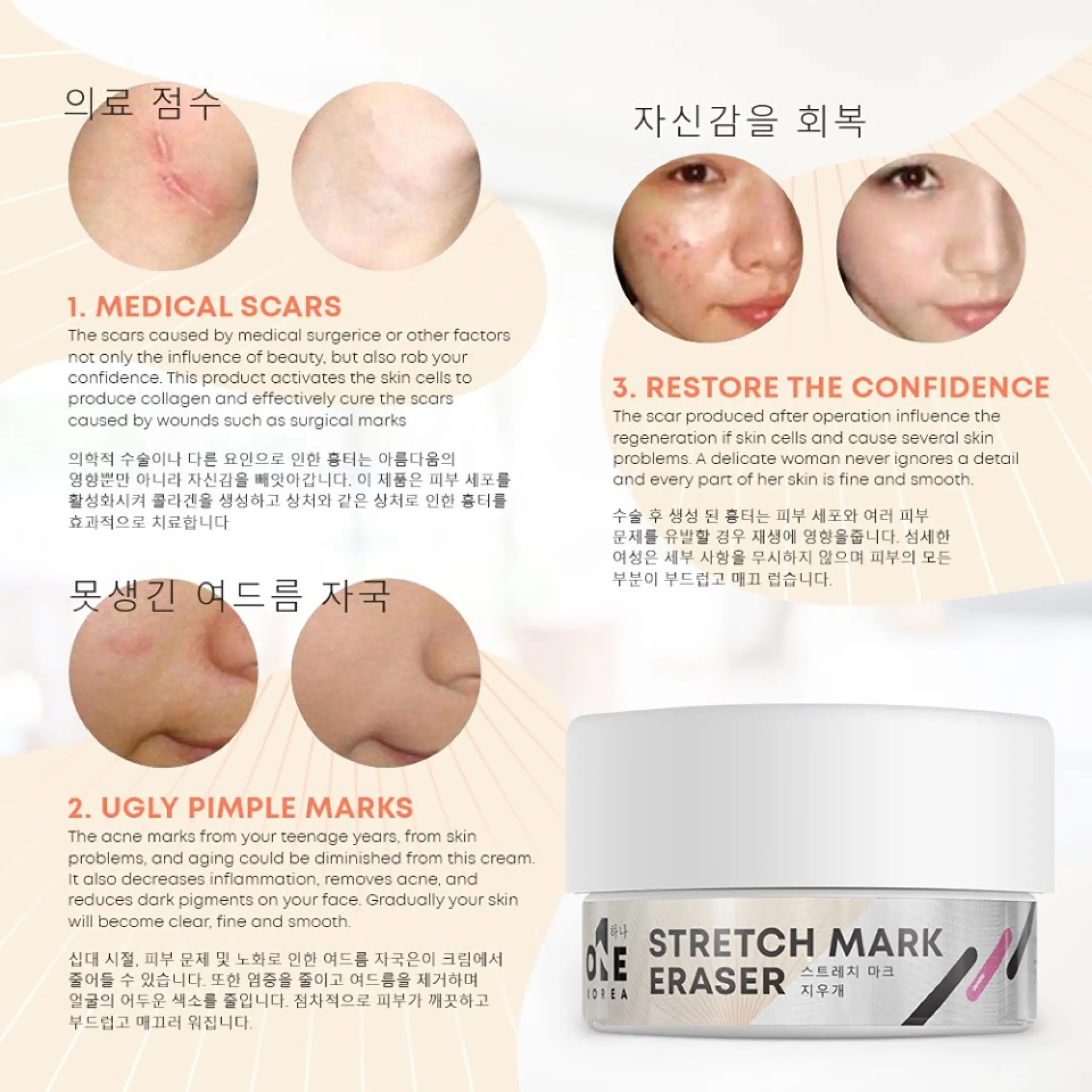 one korea stretch mark eraser