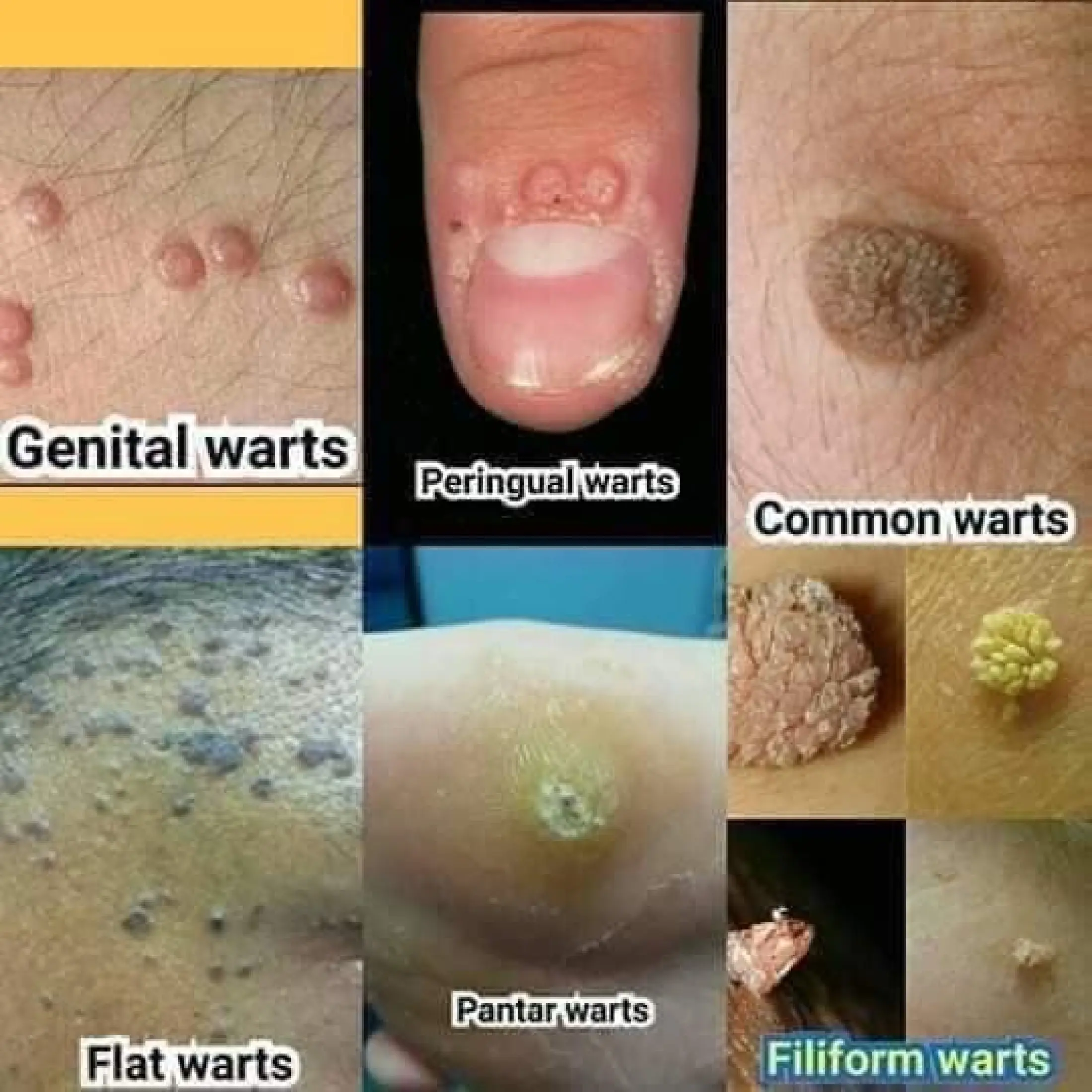 In women 😍 genital warts HPV (human